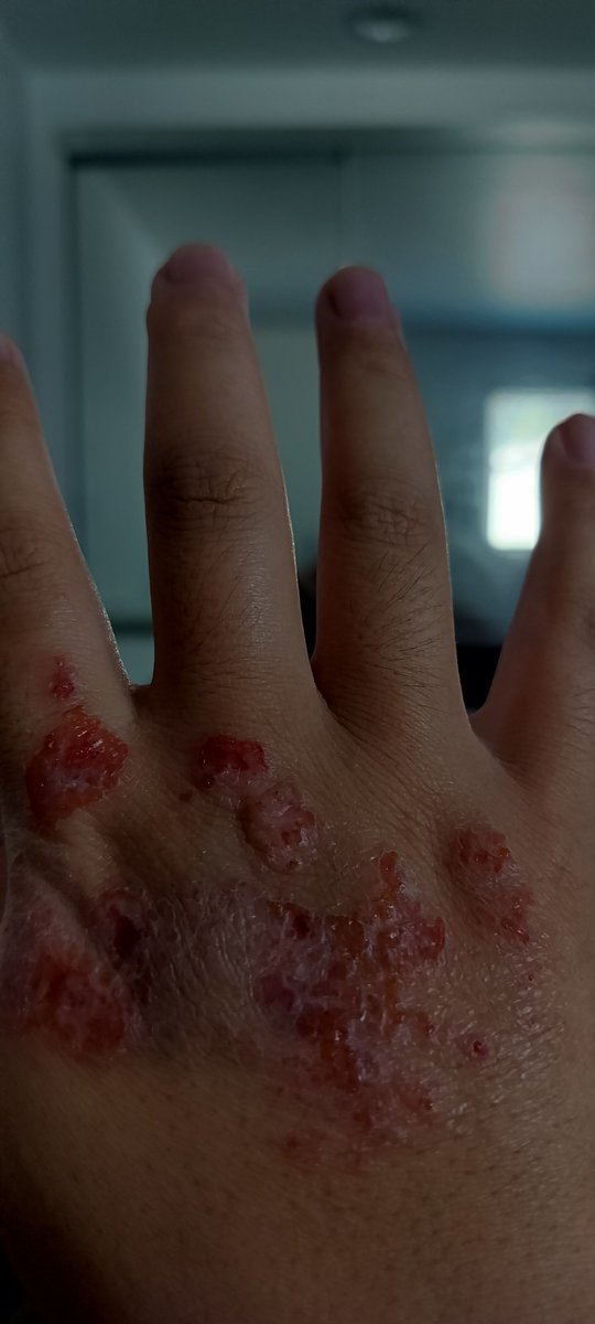 Philip_Ha__'s tweet photo. @Ninja @LaRochePosayInt Is this skin cancer https://t.co/YvQOCXDA65