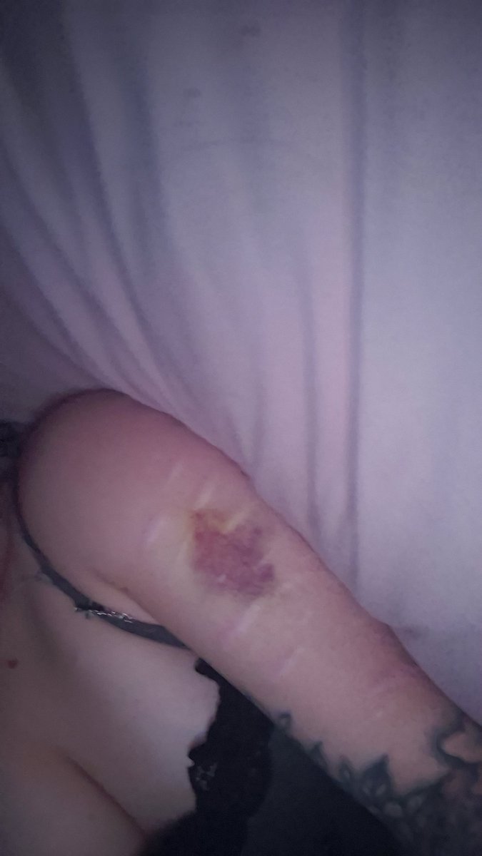 deathcli_max's tweet photo. Can someone reply to this and say this bruise is tiny and it looks like whoever gave it to me is weak asf so I can rage bait my fwb to hit me harder 😛 https://t.co/YZB7zoLfDW