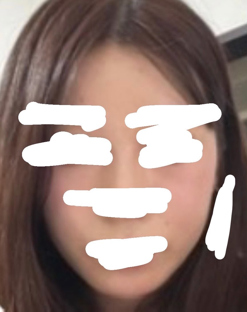 adhd155cm's tweet photo. ウルセラ500shot🇰🇷➕オンダリフト🇯🇵（4週間後）のビフォアフみて！！
チークトップ上がってるしもたつき改善してる😭もちろん無加工です！
1.2枚目 iPhone6s内カメ 
3枚目 iPhone6s ツーショット内カメ 笑顔
4枚目 iPhone17 ノーマルカメラ自撮り 
輪郭のぼかしはピアスです（身バレ防止）
 #ウルセラ https://t.co/wg6Ucf00wR