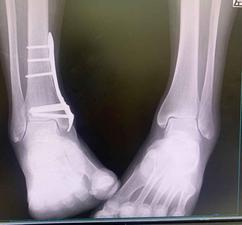 Ellecyad's tweet photo. I broke my right leg one day

and six months later I broke other one 

I broke both legs different times, so stupid https://t.co/mQRJ2NSJd7