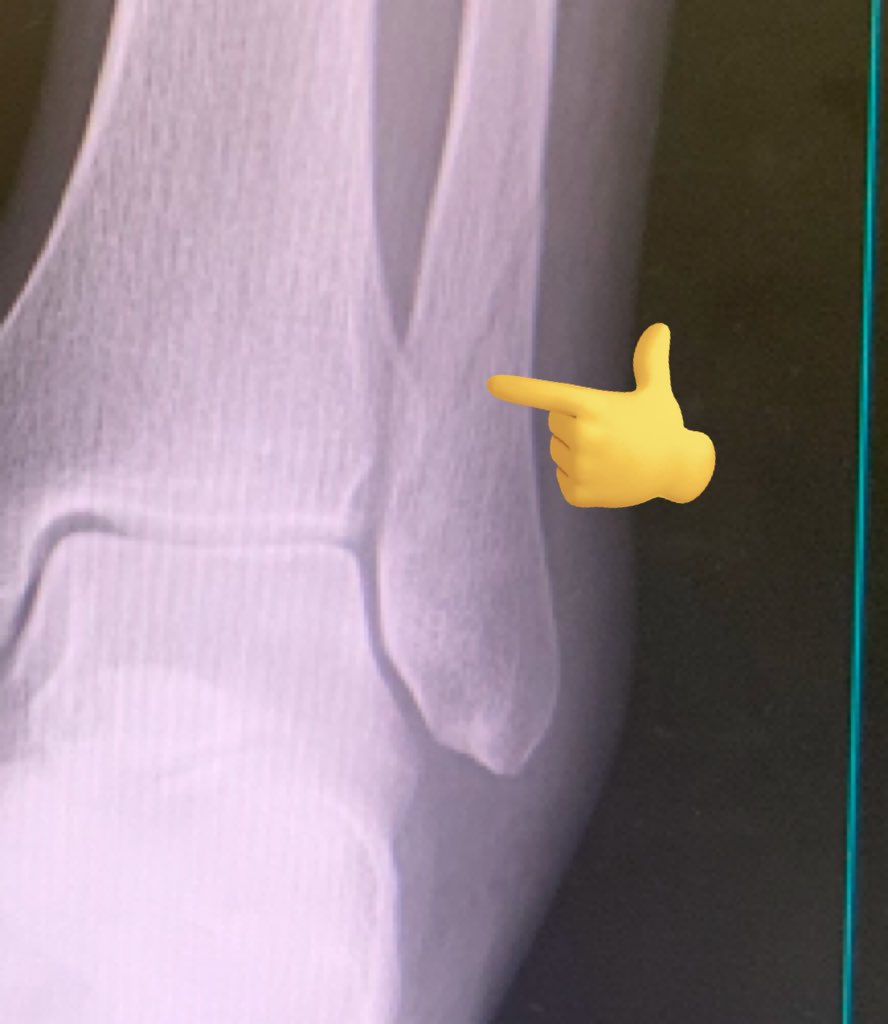 Ellecyad's tweet photo. I broke my right leg one day

and six months later I broke other one 

I broke both legs different times, so stupid https://t.co/mQRJ2NSJd7