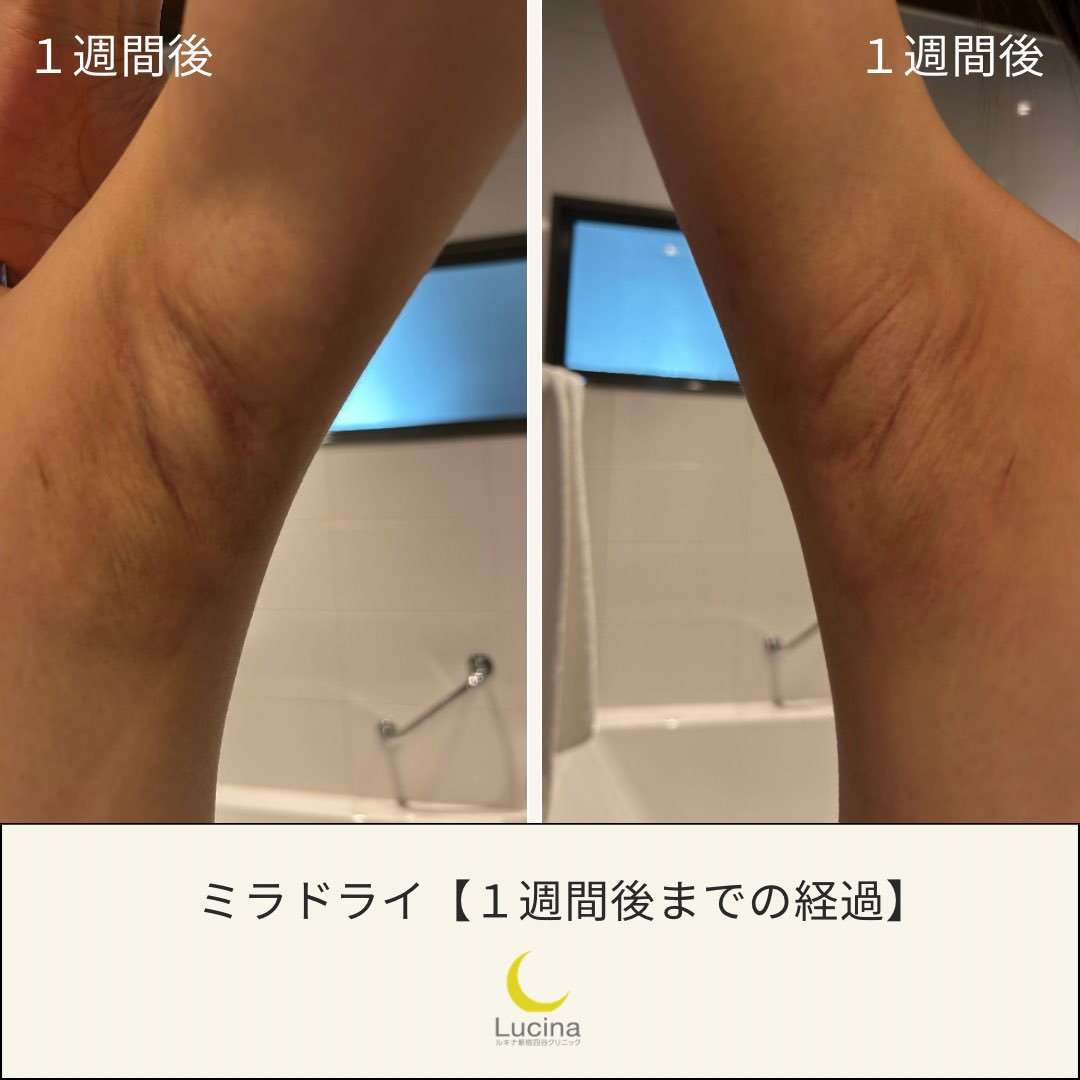 lucinaclinic's tweet photo. 【ミラドライ広範囲ダブル照射｜モニター様の経過】

実際に施術を受けられたモニター様から、経過をご報告いただきました。

〈翌日〉
・ワキ全体に強い腫れあり
・むくみが徐々に肘の方へ
・施術当日は麻酔が切れた後に強い痛みがあった
・翌朝には痛みはかなり軽減
・時々ピキッとしたつっぱるような痛みあり
・普段通りの生活は可能
・制汗剤なしでもニオイは全く気にならない
・汗も気にならない

「臭いは全く気になりませんでした！1番嬉しいです！」

〈3日後〉
写真で見ると、まだ腫れやむくみは残っていますが、翌日と比較すると少しずつ落ち着いてきています。

〈1週間後〉
・赤みはほとんど気にならない程度まで改善
・皮膚のボコボコ、波打つような感じはまだ残っている
・つっぱり感や、腕を動かした時のピキッとした感覚あり
・軽くストレッチすると楽になる
・横向きで寝るなど、ワキが圧迫されると少し痛みあり
・汗、ニオイは全く気にならない

そして何より嬉しいご感想が、

「臭いや汗は全く気にならなくて、最高です！」

ミラドライは、施術直後から腫れやむくみ、つっぱり感などがみられます。
特に広範囲ダブル照射ではしっかりと照射するため、ダウンタイムも含めて事前に経過をご理解いただくことが大切です。

当院では、施術後の経過についてもモニター様にご協力いただき、実際の経過をできるだけ分かりやすくお伝えしていきます。

※経過や効果には個人差があります。

---------------------------
ルキナ新宿四谷クリニック
〒160-0008
東京都新宿区四谷三栄町9-6 四谷三栄町スクエア1F

📞 03-6457-8212 
ホームページのLINE無料相談もご利用いただけます

診療科目：美容外科、美容皮膚科、内科

月曜日：10:00〜21:00
火曜日：10:00〜15:00  18:00〜21:00
水曜日 : 10:00〜13:00
木曜日：10:00〜21:00
金曜日：10:00〜21:00
土曜日：14:00〜19:00（隔週）
※日曜日・祝日休診

--------------------------

【ミラドライ 】
・治療内容：重度の腋窩多汗症のミラドライ治療（自由診療）
・治療期間及び回数：1回
・治療費用（税込）：188,000円〜278,000円
・主なリスクや副作用：治療部位の腫れ・痛み・色素沈着

ホームページ⬇️
https://t.co/cootOONBOz

#ミラドライ
#ミラドライ東京
#ワキガ治療
#脇汗対策
#ミラドライ経過