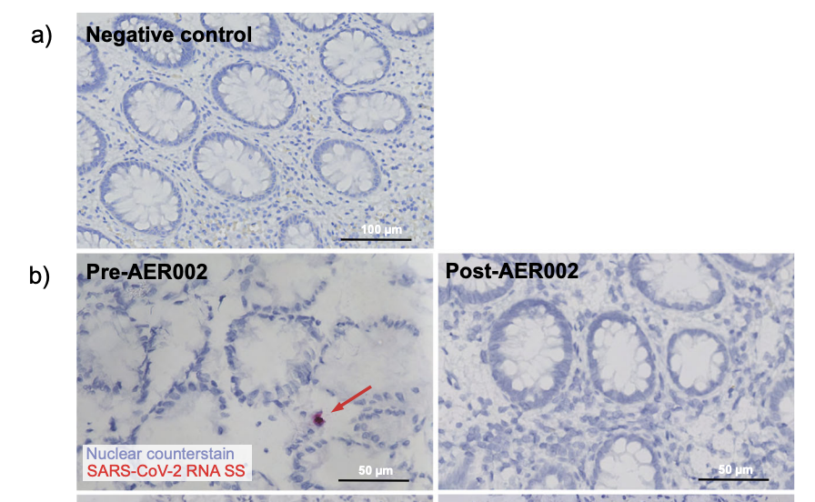 atranscendedman's tweet photo. Here's one person who had substantial clinical improvement, with viral RNA detected before treatment and not detected after.

One person is not an answer. But it is a clue. https://t.co/KpiXbhSZYI