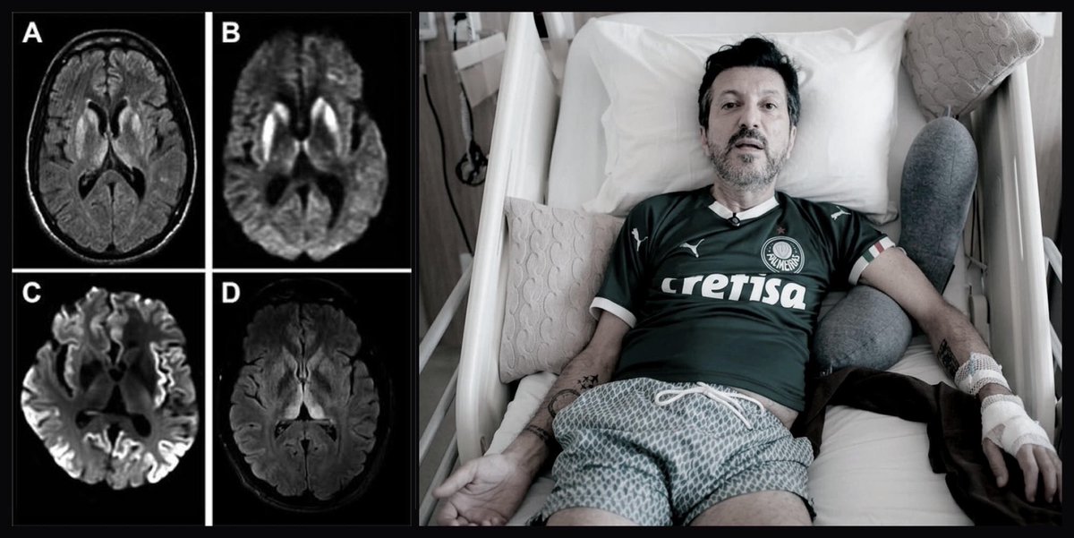 euvitin0's tweet photo. Tudo nessa doença me assusta.

O Lito Sousa recebeu o diagnóstico de Creutzfeldt-Jakob no fim de agosto. Gravou um vídeo no dia em que soube, enquanto ainda estava lúcido, porque não sabia se teria semanas ou meses. Nesta quinta, a família confirmou a morte dele, aos 59 anos.

Não é vírus. Não é bactéria. É uma proteína do próprio cérebro que muda de forma e faz as outras, iguais a ela, mudarem também. Sem DNA. Sem RNA.

O corpo não ataca. A sequência é a mesma da proteína que ele mesmo produz, então o sistema imune trata como se fosse dele. Na maior parte dos casos aparece do nada: cerca de 85% são esporádicos, sem contágio no convívio. Algo como 1 a 2 pessoas por milhão por ano.
