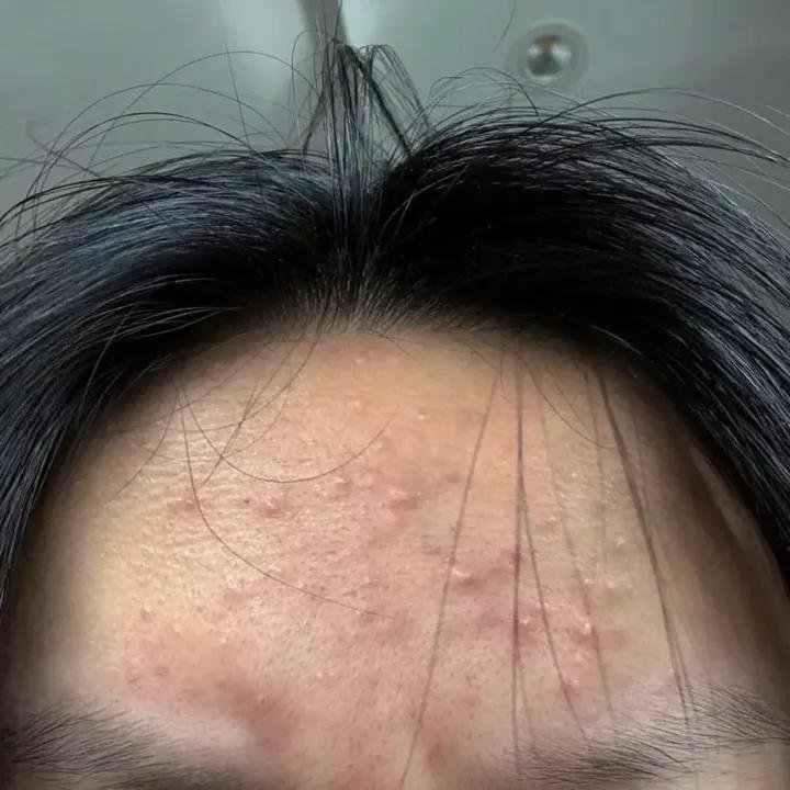 vyaaa_03's tweet photo. BERUNTUSAN DI DAHI BIKIN EMOSI 😭
Awalnya cuma iseng coba krim ini, eh setelah rutin dipakai tiap mau tidur, perubahan before-afternya lumayan bikin kaget 🥹✨
Kenapa ga dari dulu cobain ini yaa😫👀 https://t.co/6ApG4zTwqd