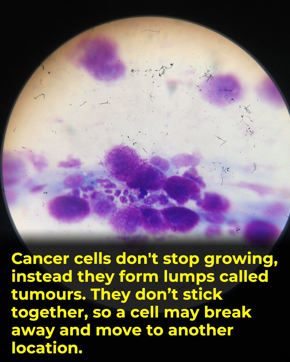 research_front's tweet photo. Cancer has no single cure because it isn’t one disease. It’s a collection of diseases that can occur throughout the body. Each type requires a different approach. As cancer grows and spreads, it can change, making treatment harder. https://t.co/uIik9qF3C6