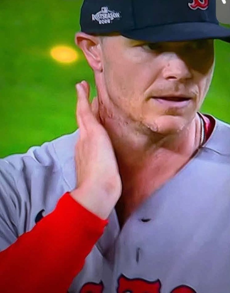 RonBF's tweet photo. I think you guys are all wrong about why Sonny Gray was pulled from the #Yankees #RedSox #MLBWildcard game. I think the manager pulled him to save him. Because people were starting to notice him tapping the pine tar on his neck.
@PTI  @RealMikeWilbon https://t.co/fCWNb89V2w