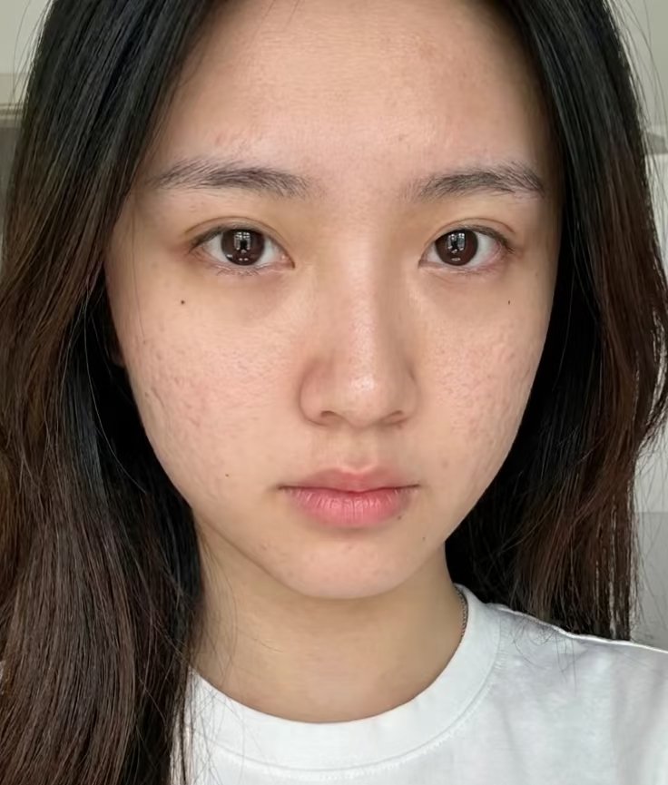 zhongmingye1's tweet photo. 有没有人觉得底子好，但脸上带痘坑的女生特别性感
#痘坑女#痘坑 https://t.co/Dg0ZNJiez9