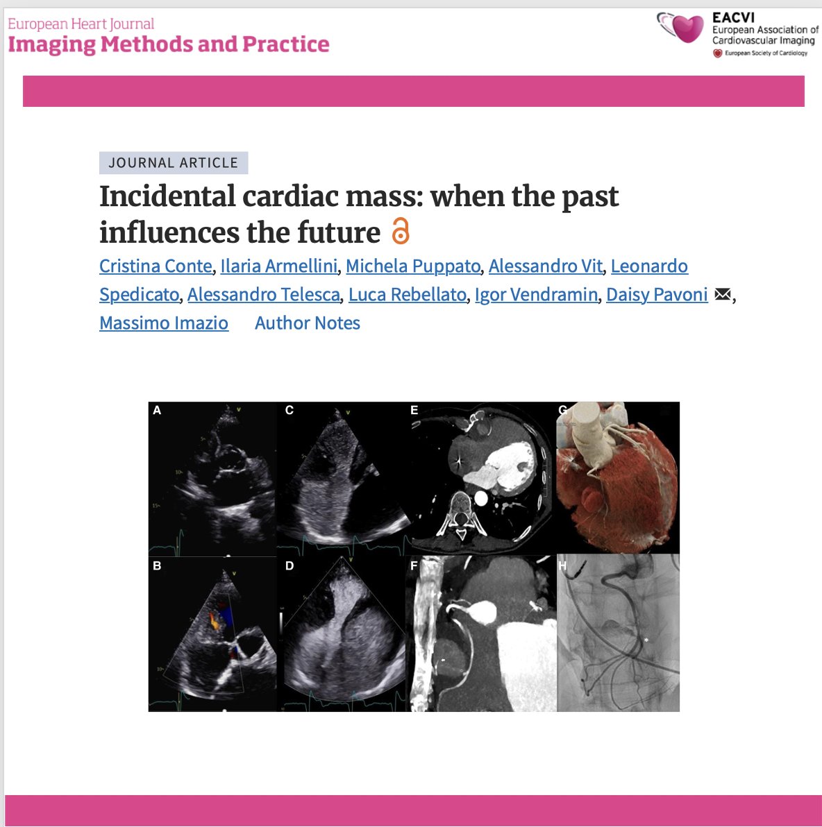 EHJIMPEiC's tweet photo. 🫀 When an incidental cardiac mass reveals a complication from the past…
This striking multimodality imaging case describes a 53-year-old woman with previous surgical atrial septal defect closure in whom an incidental mediastinal mass was ultimately identified as a right coronary artery pseudoaneurysm with peripheral thrombosis—likely related to chronic erosion from nearby sternal wires.
🔍 Key findings:
✅ Transthoracic echocardiography detected a mass adjacent to the right atrioventricular groove, with systolic–diastolic flow and suspected circumferential thrombosis.
✅ Agitated saline excluded communication with the right heart, while contrast-enhanced ultrasound demonstrated delayed enhancement, suggesting a systemic arterial supply.
✅ Coronary CT angiography revealed marked sternal malalignment, close contact with the sternal wires, and kinking of the mid-to-distal right coronary artery.
✅ Invasive angiography confirmed active RCA perfusion, supporting the diagnosis of a coronary pseudoaneurysm. Because both percutaneous and surgical treatment were considered high risk, conservative management was chosen.
💡 Clinical takeaway:
Incidental cardiac masses require more than anatomical description. Integrating echocardiography, contrast ultrasound, CT and invasive angiography can clarify vascular origin, define relationships with previous surgical material and guide complex management decisions.
📖 https://t.co/OJWa9tP76E
#CardioX #MultimodalityImaging #Echocardiography #CardiacCT #CoronaryPseudoaneurysm #CardiacMass #AdultCongenitalHeartDisease #CardiacSurgery #CardiacImaging #OpenScience