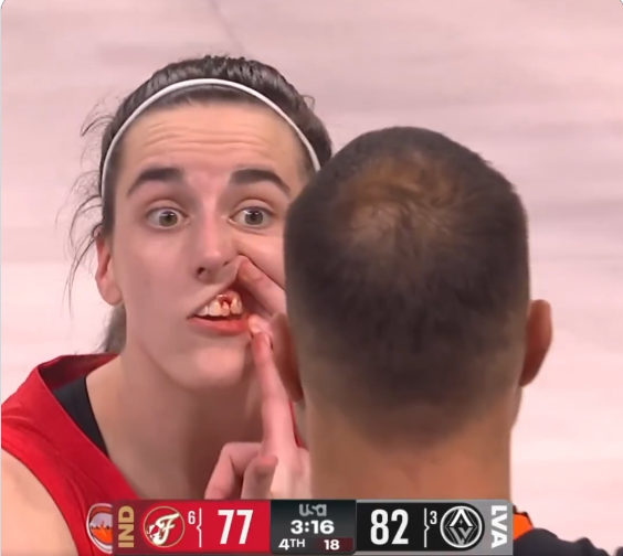 thesun_bd's tweet photo. Caitlin Clark was LEFT BLEEDING after contact with Jewell Loyd during Fever vs. Aces.

No foul was called.

Clark returned to the court, pulled down her lip, and literally showed the referee her bloody mouth. 😳

Still… no call. No review.

Clark later said: “Your guess would be as good as mine.”

Was this the right no-call? 👀

#CaitlinClark #WNBA #FeverRising