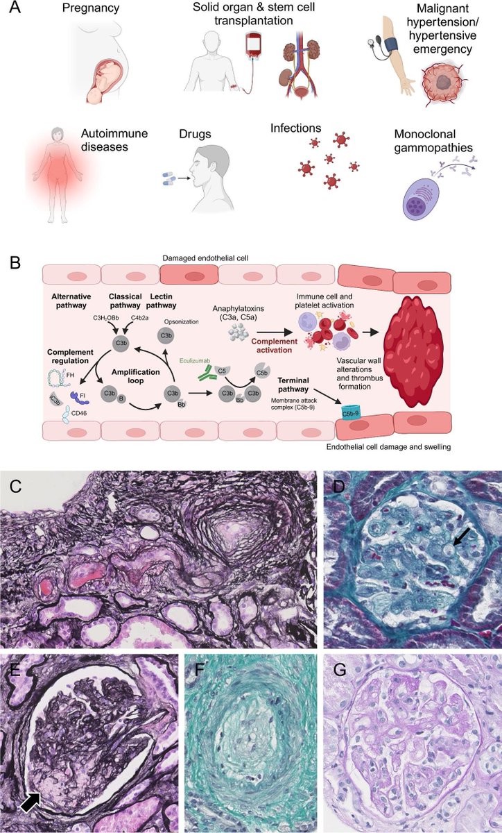 NDTsocial's tweet photo. Complement activation in secondary thrombotic microangiopathies

https://t.co/ToT8JAMBFf

This review summarizes the current understanding and future directions in the management of secondary TMA, emphasizing the potential of complement inhibition as a therapeutic strategy. https://t.co/fyYDJUx8bo