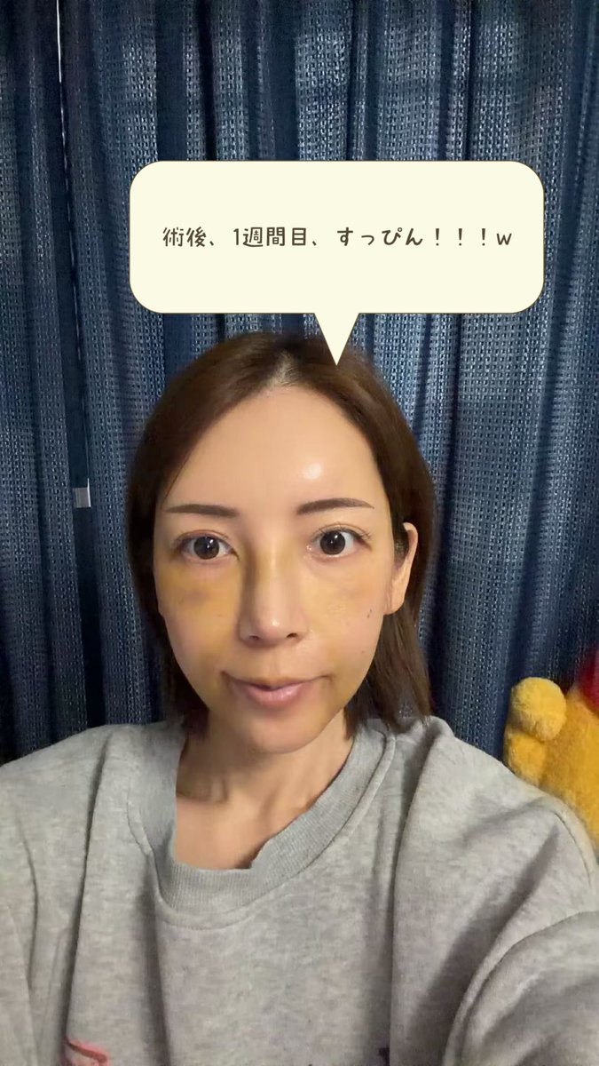 sarapi32063142's tweet photo. 第2部｜韓国の病院を調べまくってコウォンに決めるまで 🇰🇷

美容垢、症例、口コミ、チャッピーまで総動員🤣 最初は「自然な忘れ鼻」を希望してコウォンを予約。でも渡韓まで時間がありすぎて、また病院探しの無限ループ😭

#コウォン #KOWON #コウォン整形外科 #鼻ダウンタイム
#鼻フル
#鼻整形
#渡韓 https://t.co/WyG3ZPbkJA