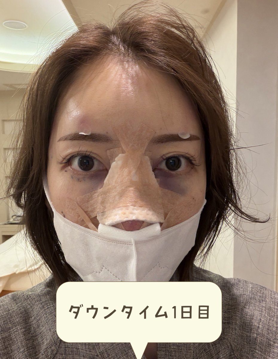 sarapi32063142's tweet photo. 第2部｜韓国の病院を調べまくってコウォンに決めるまで 🇰🇷

美容垢、症例、口コミ、チャッピーまで総動員🤣 最初は「自然な忘れ鼻」を希望してコウォンを予約。でも渡韓まで時間がありすぎて、また病院探しの無限ループ😭

#コウォン #KOWON #コウォン整形外科 #鼻ダウンタイム
#鼻フル
#鼻整形
#渡韓 https://t.co/WyG3ZPbkJA
