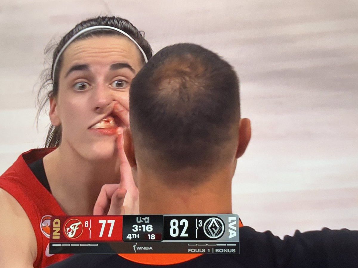 ChadFisher's tweet photo. Caitlin Clark got elbowed in the face and almost lost a tooth. So she had to show the ref. 

They didn’t even review it. https://t.co/HwigFgW1aG