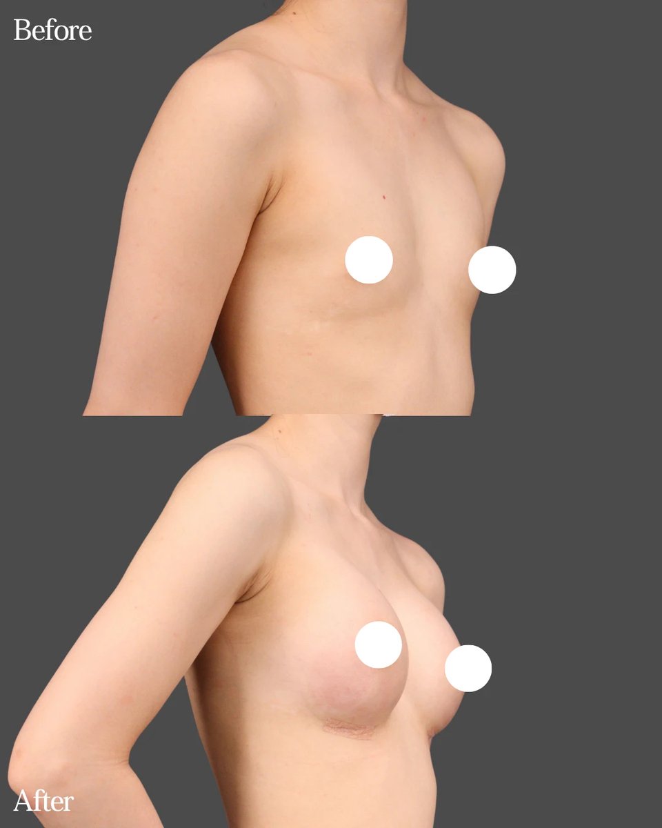 EndoscopicYossy's tweet photo. 『シリコンバッグ豊胸（デュアルプレーン法）』
痩せ型の方の症例です。

今朝お話しした「皮膚や皮下組織に厚みがない」に当てはまる方で、乳腺・皮下脂肪ともに薄い状態でした。
デュアルプレーン法をご希望され、ご来院いただきました。

そのため私は、可能な限りのサイズアップと、自然な仕上がりの両立を目指しました。

✅使用バッグ：Perle MR 300cc

✅ダウンタイム：疼痛、内出血、浮腫、倦怠感

✅リスク：出血、感染、左右差、神経・感覚障害、リップリング、被膜拘縮、ボトムアウト、傷跡、BIA-ALCL、凹凸、しこり形成、熱傷、皮膚障害など

✅料金：
【シリコンバッグ豊胸】
通常：880,000円　モニター：704,000円
【コンデンスリッチ脂肪豊胸（脂肪採取2部位）】
通常：1,320,000円　モニター：924,000円
【ハイブリッド豊胸（シリコンバッグ＋脂肪豊胸）】
通常：1,650,000円　モニター：1,320,000円
デュアルプレーン法：+220,000円
内視鏡：+110,000円
採血、麻酔代　別途

#豊胸 #シリコンバッグ豊胸