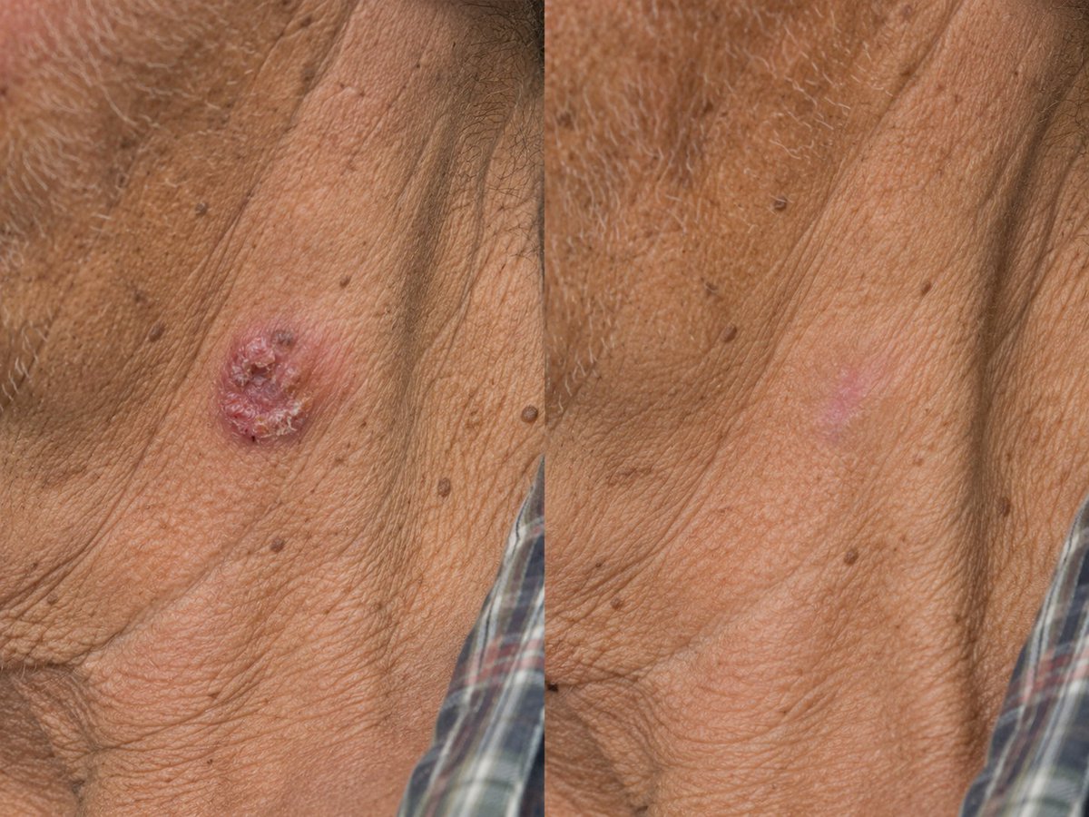 skymeds_store's tweet photo. I never thought I'd be writing this.
My dad is 68. Used to farm. Now he's fighting colon cancer.

Five weeks ago, I put him on a protocol I put together from what I learned here on X:

• 72mg Ivermectin (daily)
• 444mg Fenbendazole
• 4,000mg Vitamin C
• 32oz Hibiscus tea

Also fasting, sun, low‑inflammatory food.

Yesterday, his new CT scan came back. Tumor shrinkage.

But here's the part that really got me.

Dad also had this ugly spot on his neck. Basal cell. Been there for years. Growing.

So I did something else. I took the same Ivermectin paste – the one from the farm store – and dabbed it on that spot. Three times a day.

One month later? The spot is gone. Completely cleared.

He called me this morning. His voice was different. "It's gone, son."

And me?
I've been taking a smaller dose myself – 24mg Ivermectin + 444mg Fenbendazole – just to see what happens.

My sleep fixed itself. I wake up without an alarm. I don't crave sugar anymore. I don't even want to over‑eat.

I feel… calm.

Look, I know how this sounds. Horse paste for cancer? For skin cancer? I laughed too. Then I watched my dad's scans change.

I'm not a doctor. I'm just a son who refused to give up.

Healing is always possible. Even when it looks crazy.