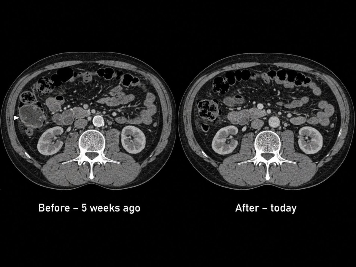 skymeds_store's tweet photo. I never thought I'd be writing this.
My dad is 68. Used to farm. Now he's fighting colon cancer.

Five weeks ago, I put him on a protocol I put together from what I learned here on X:

• 72mg Ivermectin (daily)
• 444mg Fenbendazole
• 4,000mg Vitamin C
• 32oz Hibiscus tea

Also fasting, sun, low‑inflammatory food.

Yesterday, his new CT scan came back. Tumor shrinkage.

But here's the part that really got me.

Dad also had this ugly spot on his neck. Basal cell. Been there for years. Growing.

So I did something else. I took the same Ivermectin paste – the one from the farm store – and dabbed it on that spot. Three times a day.

One month later? The spot is gone. Completely cleared.

He called me this morning. His voice was different. "It's gone, son."

And me?
I've been taking a smaller dose myself – 24mg Ivermectin + 444mg Fenbendazole – just to see what happens.

My sleep fixed itself. I wake up without an alarm. I don't crave sugar anymore. I don't even want to over‑eat.

I feel… calm.

Look, I know how this sounds. Horse paste for cancer? For skin cancer? I laughed too. Then I watched my dad's scans change.

I'm not a doctor. I'm just a son who refused to give up.

Healing is always possible. Even when it looks crazy.