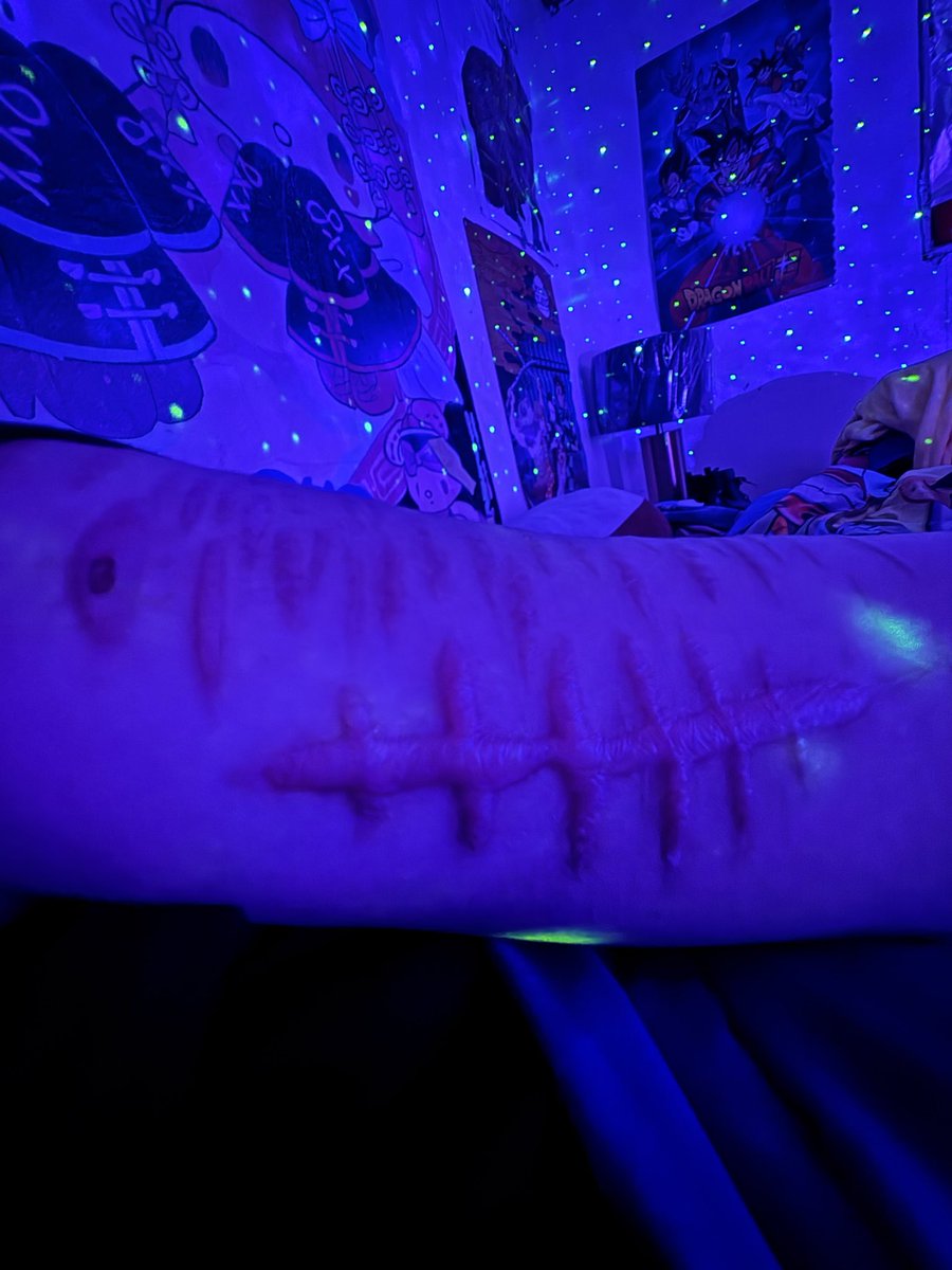 pinnziq's tweet photo. I literally hate this scar i would get rid of it sigh
its itchy 24/7 it hurts to scratch https://t.co/CzndqoWNps