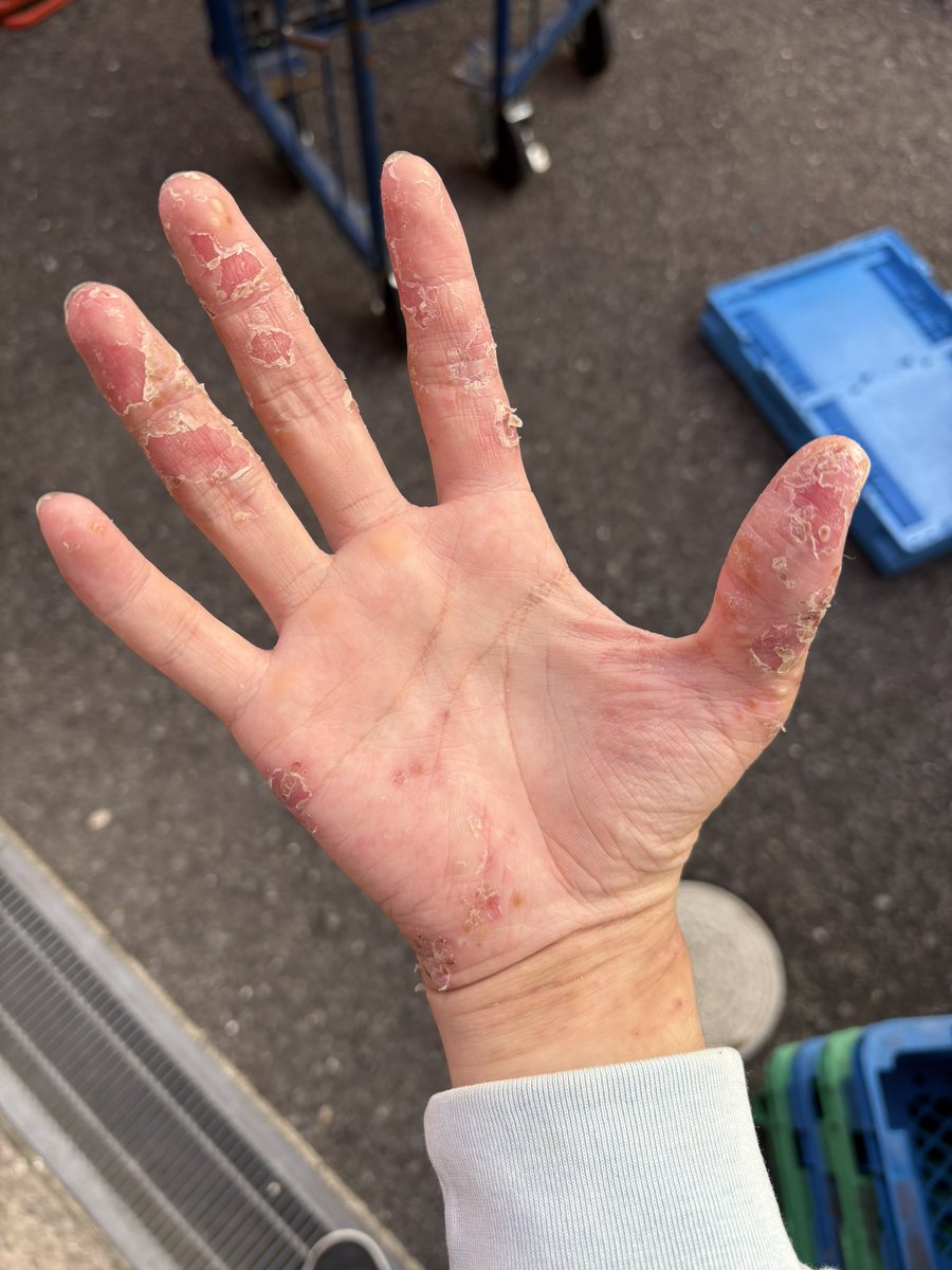 kitamu_YH's tweet photo. 治ってきたなぁって分かるから嬉しくはあるけど見た目もうちょいなんとかならんのけ？ https://t.co/prbrPwTA3o