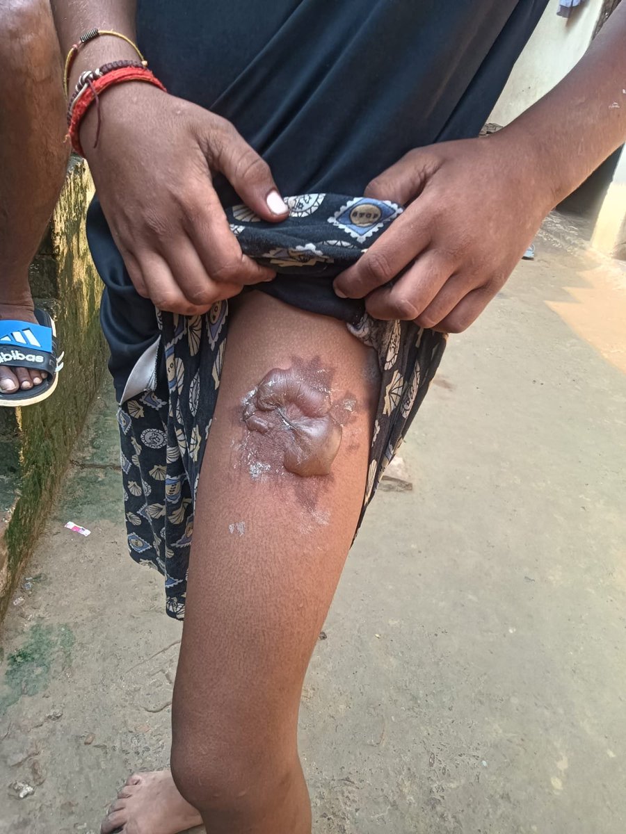 tiwarichotu70's tweet photo. @Uppolice @DIGDevipatan @dgpup 
@bahraichpolice महोदय जी तत्कालीन संज्ञान लेने की कृपा करें 

महोदय जी 15 वर्षी नाबालिक  बालक हर्षित तिवारी पर शिव कुमारी तिवारी ने गरम चाय फेंक कर जानलेवा हमला किया है। 

जो बेहद नंदिनी और अमानविये कृत्य है।

पता गोधना बेलभरिया https://t.co/YxPhcfRnv0