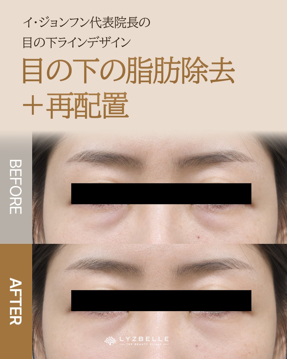 drleejonghoon's tweet photo. イ・ジョンフン代表院長が考える  
目の下は「減らすだけ」ではなく、整えるという選択。
 
目の下の脂肪除去＋再配置

ふくらみが強い部分はすっきり整えながら、  
くぼみや影が目立ちやすい部分とのバランスを見て  
なめらかな目の下ラインを目指します✨

イ・ジョンフン代表院長が  
目元の状態・左右差・お顔全体とのバランスを確認しながら、  
自然ですっきりとした印象へ導きます🕊️

・目の下のふくらみが気になる方  
・クマや影が目立ちやすい方  
・疲れて見える印象を整えたい方  
・自然な目元改善をご希望の方

ぜひお気軽にご相談ください☺️

୨୧┈┈┈┈┈┈┈┈┈┈┈  
💬 ご相談・ご予約（日本語OK）  
💚 LINE ID https://t.co/AHsyz2c4Hh
📍 ソウル・狎鴎亭 カロスキル  
୨୧┈┈┈┈┈┈┈┈┈┈┈

#リズベル美容クリニック #イジョンフン #目の下脂肪除去 #目の下脂肪再配置 #クマ改善 #目元整形 #韓国美容 #狎鴎亭美容クリニック