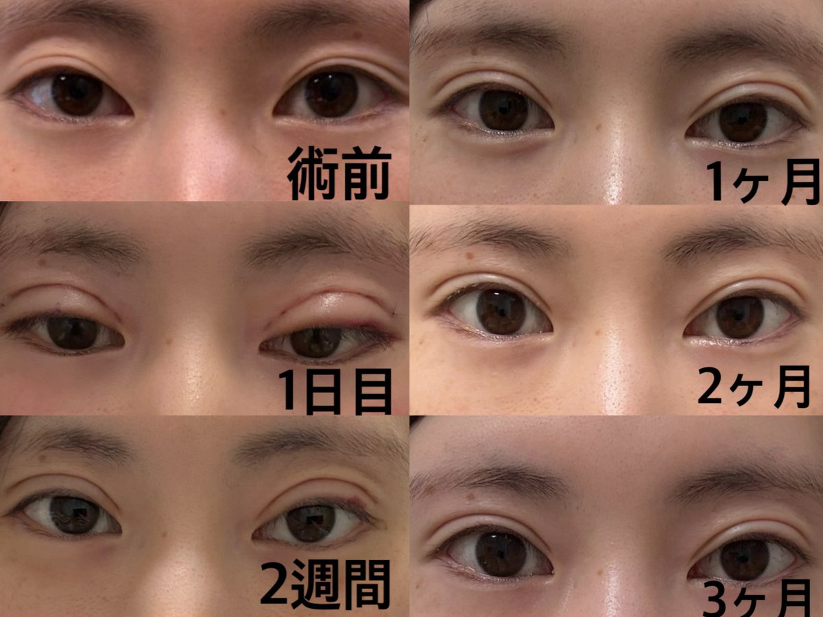 mwyu_o's tweet photo. 4月にプロミス美容外科(@promiseplasty )にて自然癒着してきました✨️
術前も術後も加工無しです！
ラインく��きりになってうれしい😭
思ってたよりダウンタイム短めですぐ腫れ引いた気がする
目尻切開とタレ目形成もやりたいなあ https://t.co/So9u53yZ0Q