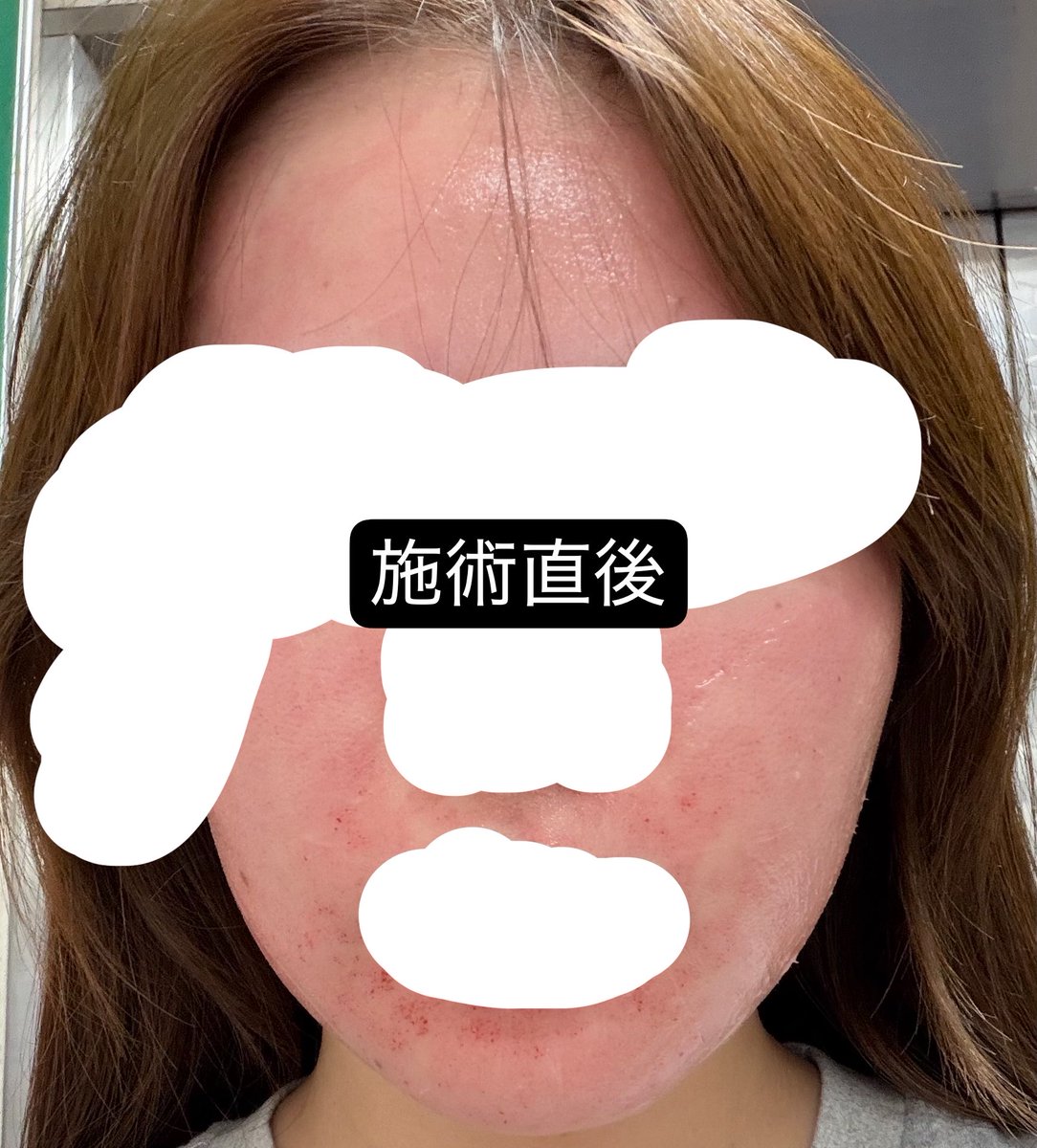 シルククリニックでピコダブル受けてきました🦋
施術後は顔が真っ赤で通行人にめちゃくちゃ見られた😂
でも3日後にはファンデで赤みを隠せるくらいに◎
麻酔クリームは必須です‼️‼️‼️‼️‼️ https://t.co/An96odOn1q
