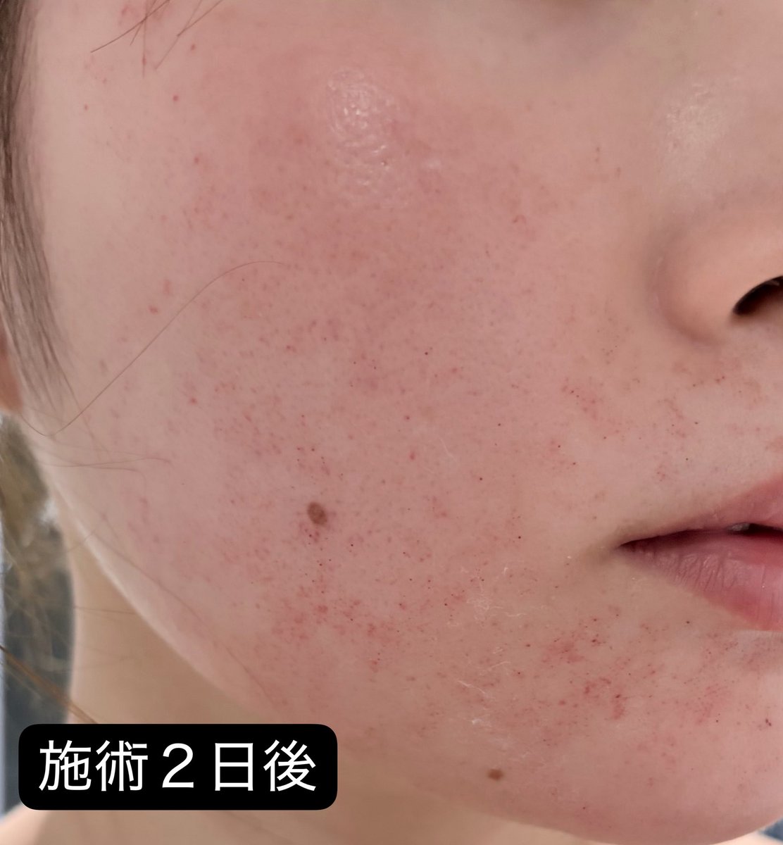シルククリニックでピコダブル受けてきました🦋
施術後は顔が真っ赤で通行人にめちゃくちゃ見られた😂
でも3日後にはファンデで赤みを隠せるくらいに◎
麻酔クリームは必須です‼️‼️‼️‼️‼️ https://t.co/An96odOn1q
