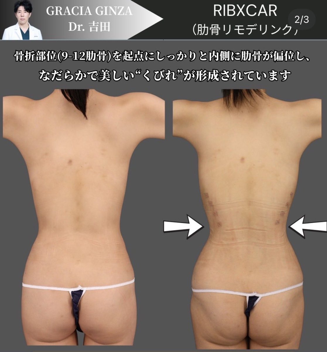 EndoscopicYossy's tweet photo. くびれのために、もう大きな傷はいらない
肋骨のくびれ形成は術式で傷が全然違います。

従来：皮膚切開あり：傷が大きい
RibXcar（肋骨リモデリング）：針穴のみ

ただし骨に関わる手術なので、医師の経験は必ず確認を。 https://t.co/H2UEnxlPE9