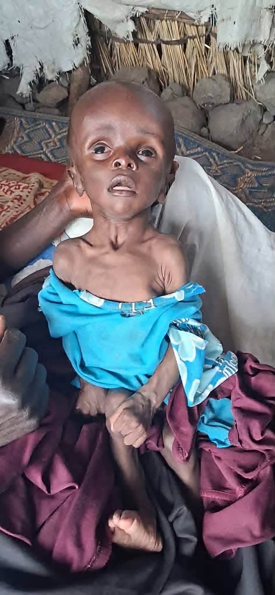 noeleeisaround's tweet photo. They arrived from El Fasher in this condition
Severe, level-five malnutrition.
Severe pelvic infections in women and uterine problems.
Severe vitamin deficiencies.
Your donations help them access the nutritious food and appropriate medical treatment they urgently need. https://t.co/Xv2y0pnzCT