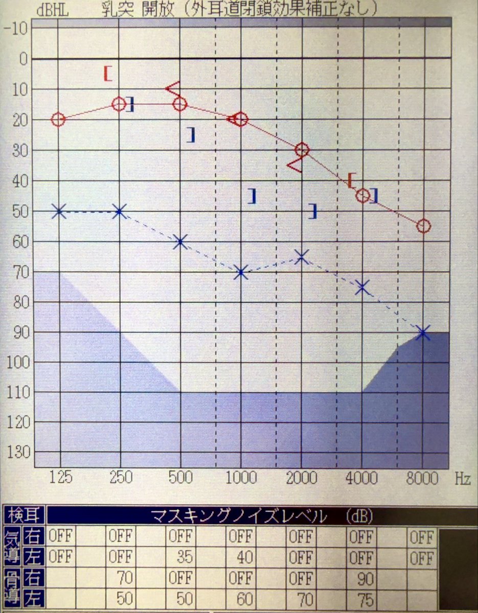 OtoLab_official's tweet photo. 中耳炎性内耳炎のオージオグラム例になります。

前ポストでは左4kHzの骨導閾値は、実際はもう少し悪いのでは？ということです。

とは言っても、この場合はしっかり混合性難聴ですし、他の所見もあれば4kHzの閾値はそれほど重要ではなさそうです。

ただし、軽度難聴の場合は気骨導差が小さくなり、骨導が残っているかどうかがわかりにくくなるため、骨導閾値を正確に測定できるかが重要となってきます。
