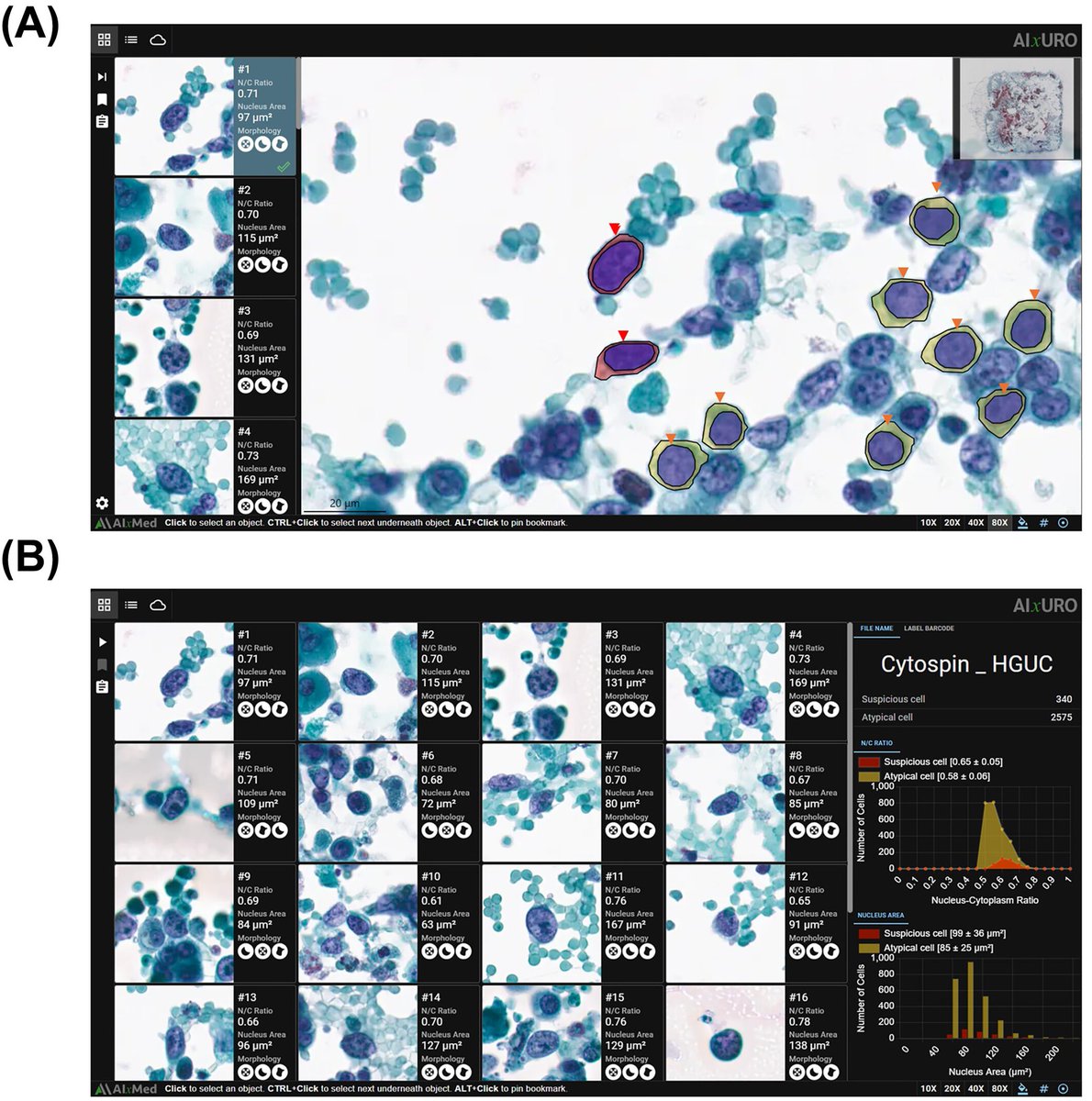 CancerCytopath's tweet photo. 🔬 Enhancing urothelial carcinoma diagnosis with artificial intelligence–integrated urine cytology: Biopsy-validated accuracy and efficiency gain

https://t.co/oXKm1hRS3F

#CytoPath @SamKhader https://t.co/B2SsAUsGCi