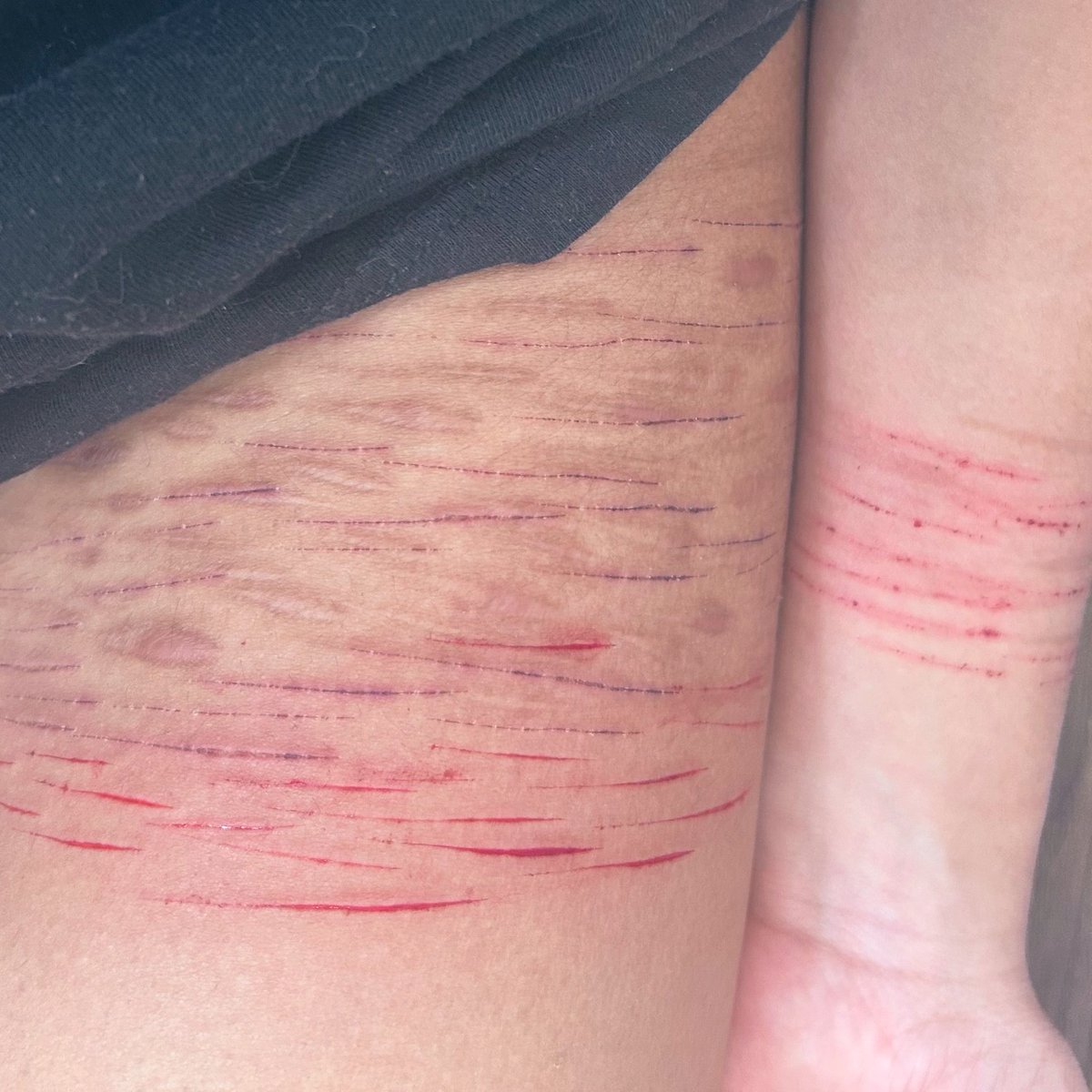Fatal4lyfe's tweet photo. Both thighs and my wrist tonight🙃
#shtwt #catscratch #styro #sfxmakeup #fake #moothunt〃・ https://t.co/ciqvNJ1HJG