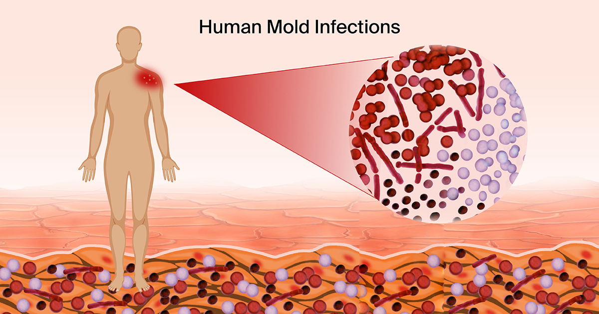 JoF_MDPI's tweet photo. 🍄 Diagnosis and Management of Human Mold Infections, 2nd Edition

Guest Editor: Prof. Dr. Suzana Otašević, Medical Faculty, University of Niš, Serbia.

📅 Submission deadline: 30 November 2026

🔗 Submit your manuscript: https://t.co/6bx4NTI4E1

#MedicalMycology #Mycology #JoF https://t.co/qZ280LDPa4
