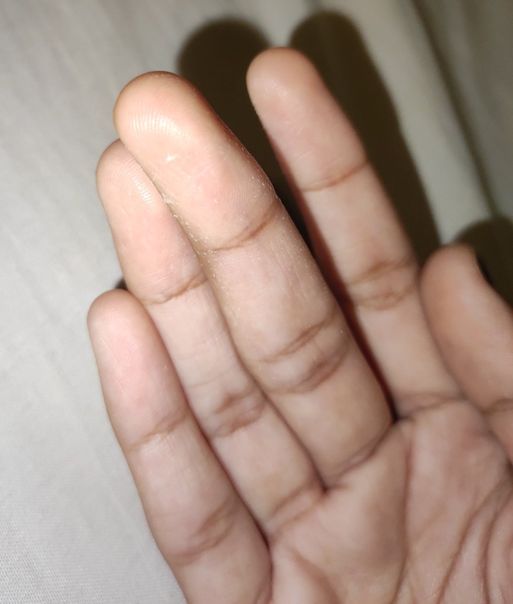 lovelibaseone's tweet photo. guys my fingers are genuinely peeling https://t.co/cQVFOaJkJy