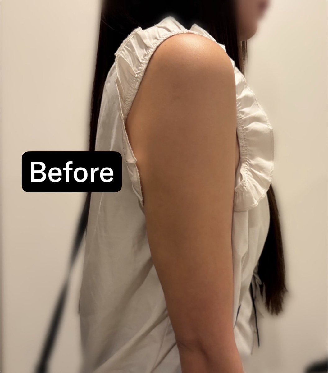 【二の腕 脂肪吸引】
もうすぐ1ヶ月が経つけどこの変化!
まだ腫れてるはずだけど既に細い。というか術直後から細くなってた。
【DT】
割と軽かった!
DT3日目ぐらいまでは擦れて腕が痒いのが辛い。
アザになると思って長袖沢山買ったけどアザも殆どできなかった。
【効果】
有名な医師にお願いしただけあって、手術は本当にあっという間で麻酔の負担が皆無。
理想のカリカリ二の腕になりました🫶
経過も楽しみ。