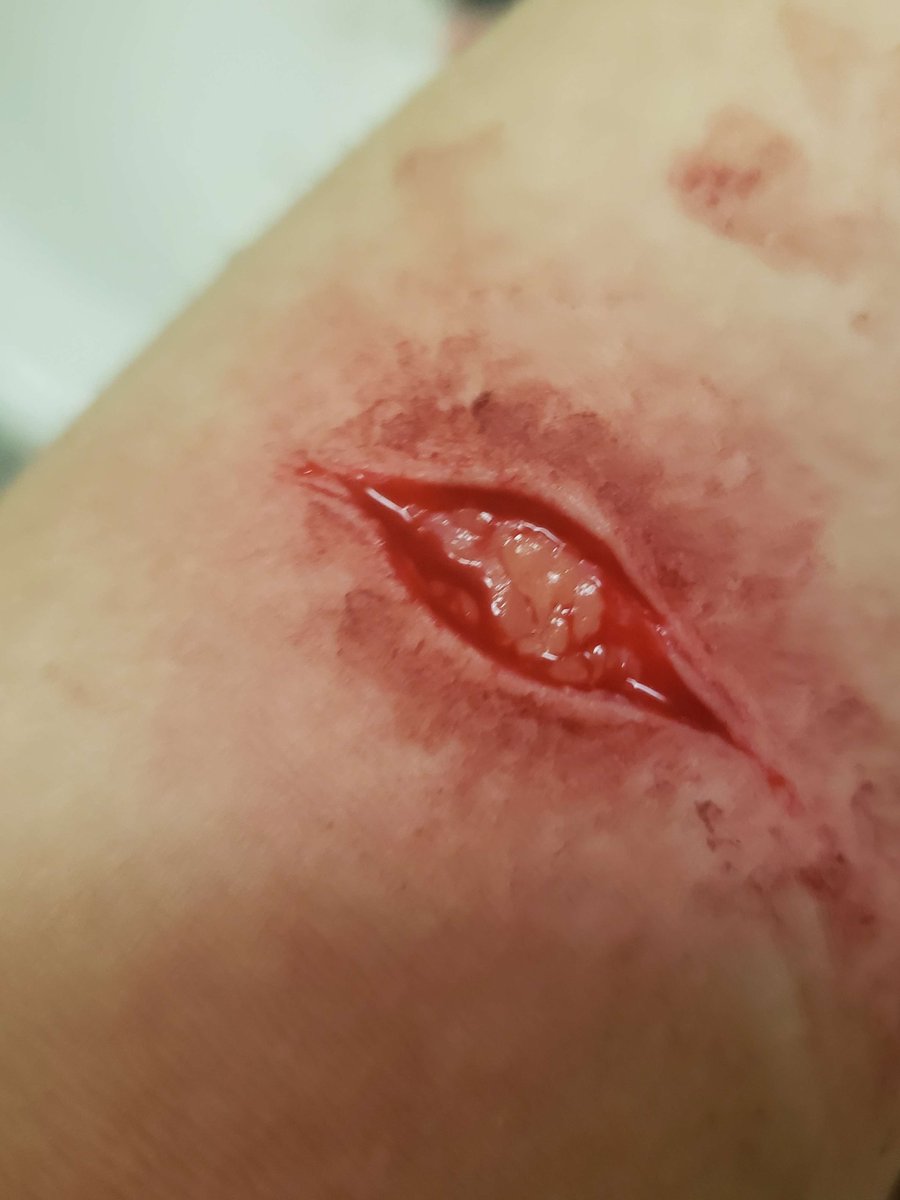 _burnmydreadd's tweet photo. js found this from the first time i hit beans in 2023 oh my god i was 11 in 5th grade and i already wanted to endmy shit no wonder i am the way i am now 🫩 the rest of my arm looked so empty i think i miss it i wish i never started https://t.co/xSayD2ssTZ