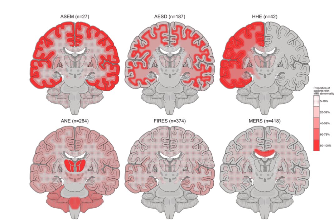 andreuvilaseca7's tweet photo. It’s not easy to find the perfect topic for a meta-analysis, but parainfectious (rather than postinfectious, as most patients still have fever at onset) neurological encephalopathic syndromes are a perfect one!

Great summary of this highly heterogeneous topic in @TheLancet !

Key messages:
• In adults, consider only ANE, FIRES, and MERS.
• Rotavirus is associated with MERS; influenza/SARS-CoV-2 with ANE, and HHV6 with AESD.
• High heterogeneity in MRI patterns and outcomes, with ANE having the worst outcomes despite treatment, suggesting that even umbrella term, they probably are different pathomechanims.
• And, of course, CSF helps rule out infection but, so far, does not aid much in diagnosis!

#Neurology #ITEM #Autoimmune
