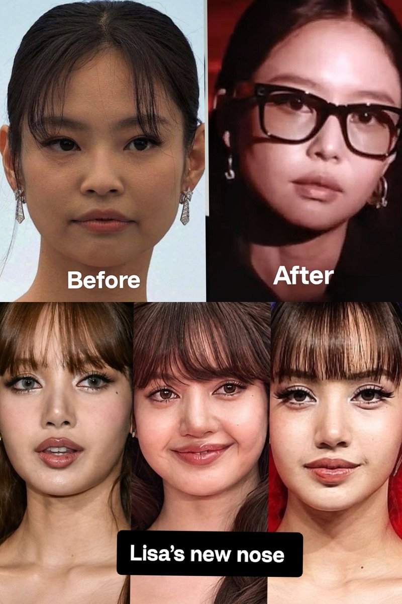 bblboba's tweet photo. [INFO🚨]

A famous Korean plastic surgeon revealed that Blackpink Lisa’s new nose was the nose Jennie used as a reference to redo her own. https://t.co/ShmestPOtN