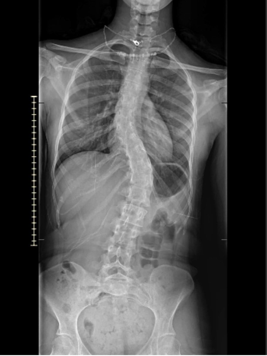 Snickerdoddles2's tweet photo. Could use some prayers and positive vibes today. My 22 year old daughter is under going spinal fusion for scoliosis that she has been dealing with since middle school. She is scared to death as well as myself. It’s her first surgery and a major one. Fusing 13 vertebrate. https://t.co/cZzbxAGQmN