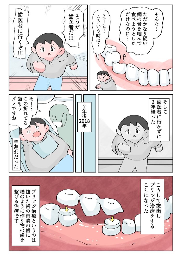 omocoro's tweet photo. インプラント体験記　かなり噛む部分の歯を２本連続で失っただけなのに…
（1/7） https://t.co/Frz4Rpt1Yj