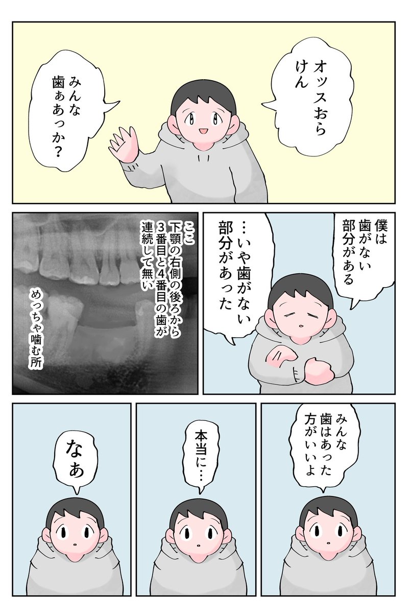 omocoro's tweet photo. インプラント体験記　かなり噛む部分の歯を２本連続で失っただけなのに…
（1/7） https://t.co/Frz4Rpt1Yj