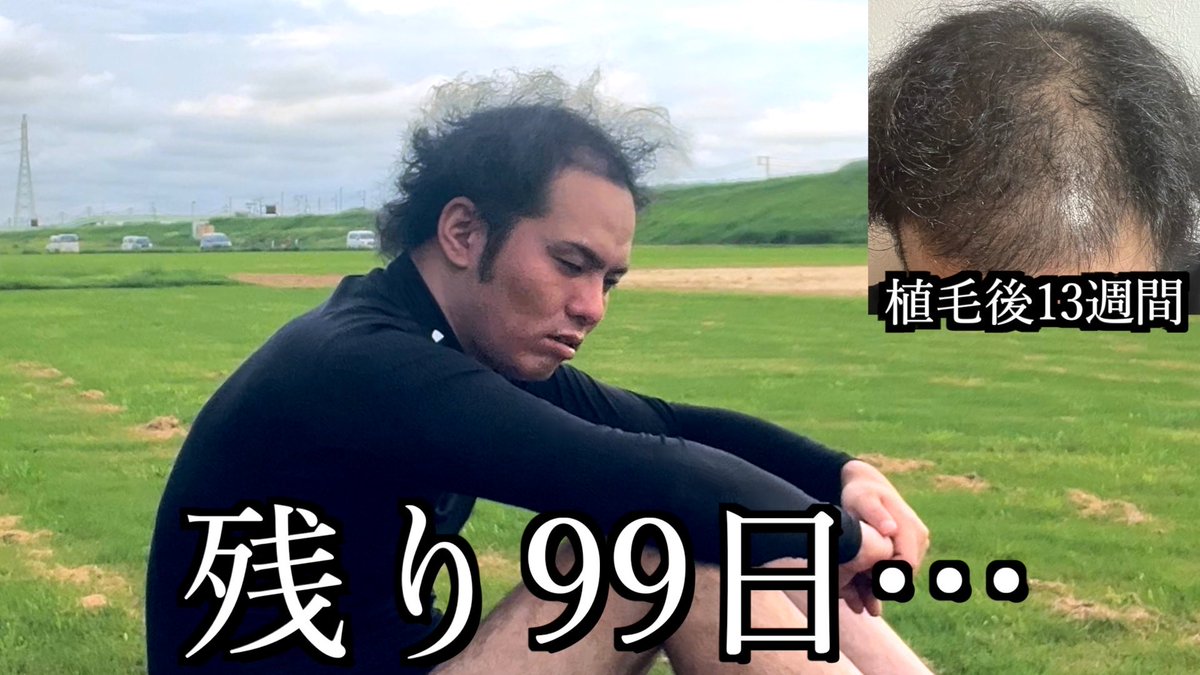 legend_YouTube_'s tweet photo. 34歳ハゲ、植毛後。地獄の100日間を始めます。 https://t.co/xHr0uC4JBi @YouTubeより https://t.co/8LVgoOQXjt