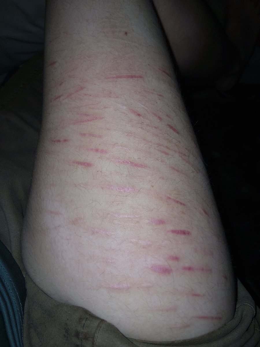fellsfalling's tweet photo. Scars n healing MAKEUP FOR HALLOWEEN PRACTICE ENHANCED W AI I DO NOT PROMOTE SH
anyway
#sh #shtwt #styrotwt #styro #scars #fx https://t.co/GM3poeDcpQ