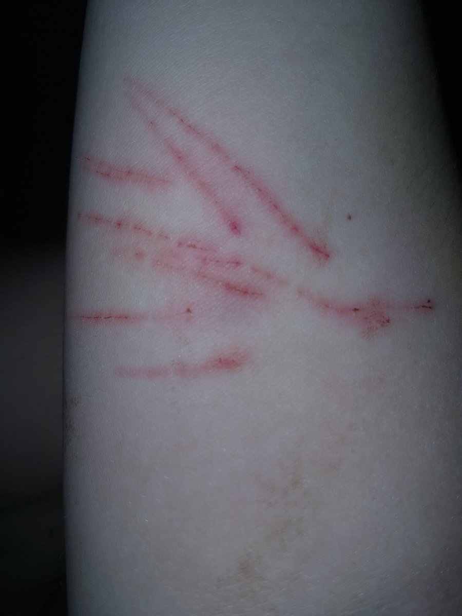 fellsfalling's tweet photo. Scars n healing MAKEUP FOR HALLOWEEN PRACTICE ENHANCED W AI I DO NOT PROMOTE SH
anyway
#sh #shtwt #styrotwt #styro #scars #fx https://t.co/GM3poeDcpQ