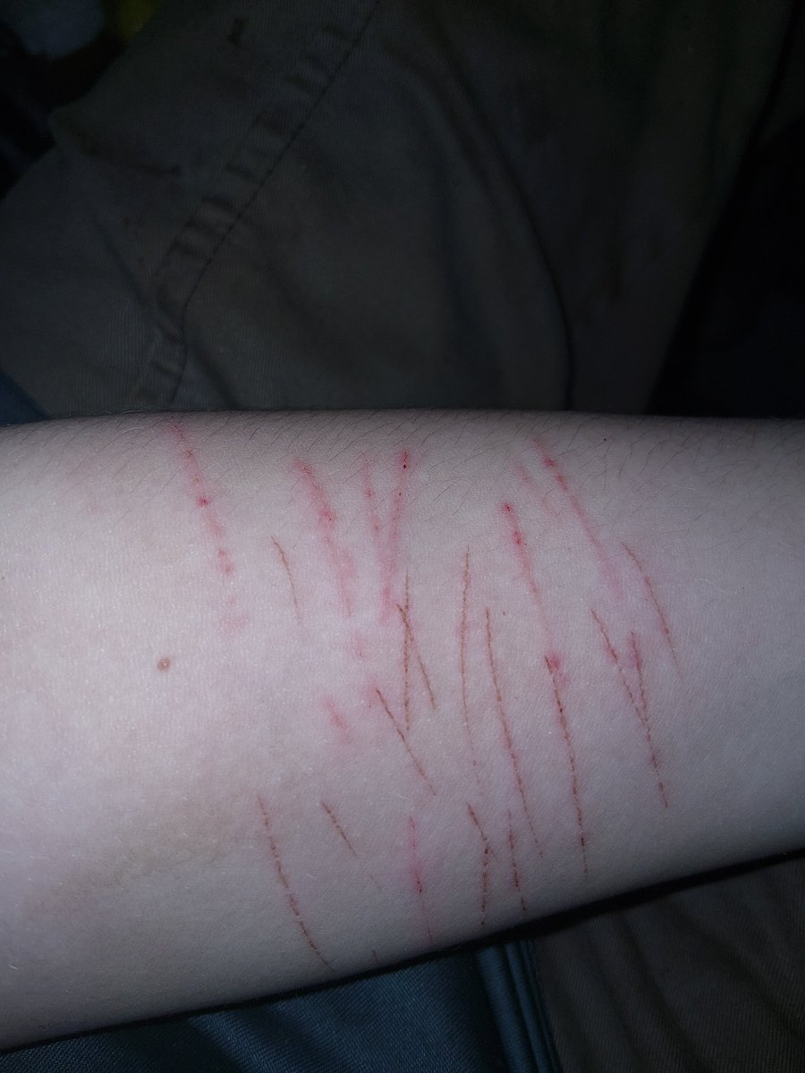 fellsfalling's tweet photo. Scars n healing MAKEUP FOR HALLOWEEN PRACTICE ENHANCED W AI I DO NOT PROMOTE SH
anyway
#sh #shtwt #styrotwt #styro #scars #fx https://t.co/GM3poeDcpQ