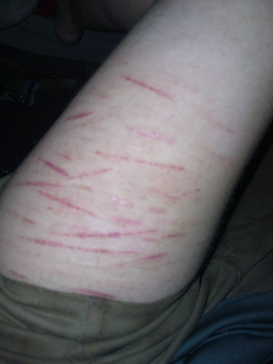 fellsfalling's tweet photo. Scars n healing MAKEUP FOR HALLOWEEN PRACTICE ENHANCED W AI I DO NOT PROMOTE SH
anyway
#sh #shtwt #styrotwt #styro #scars #fx https://t.co/GM3poeDcpQ