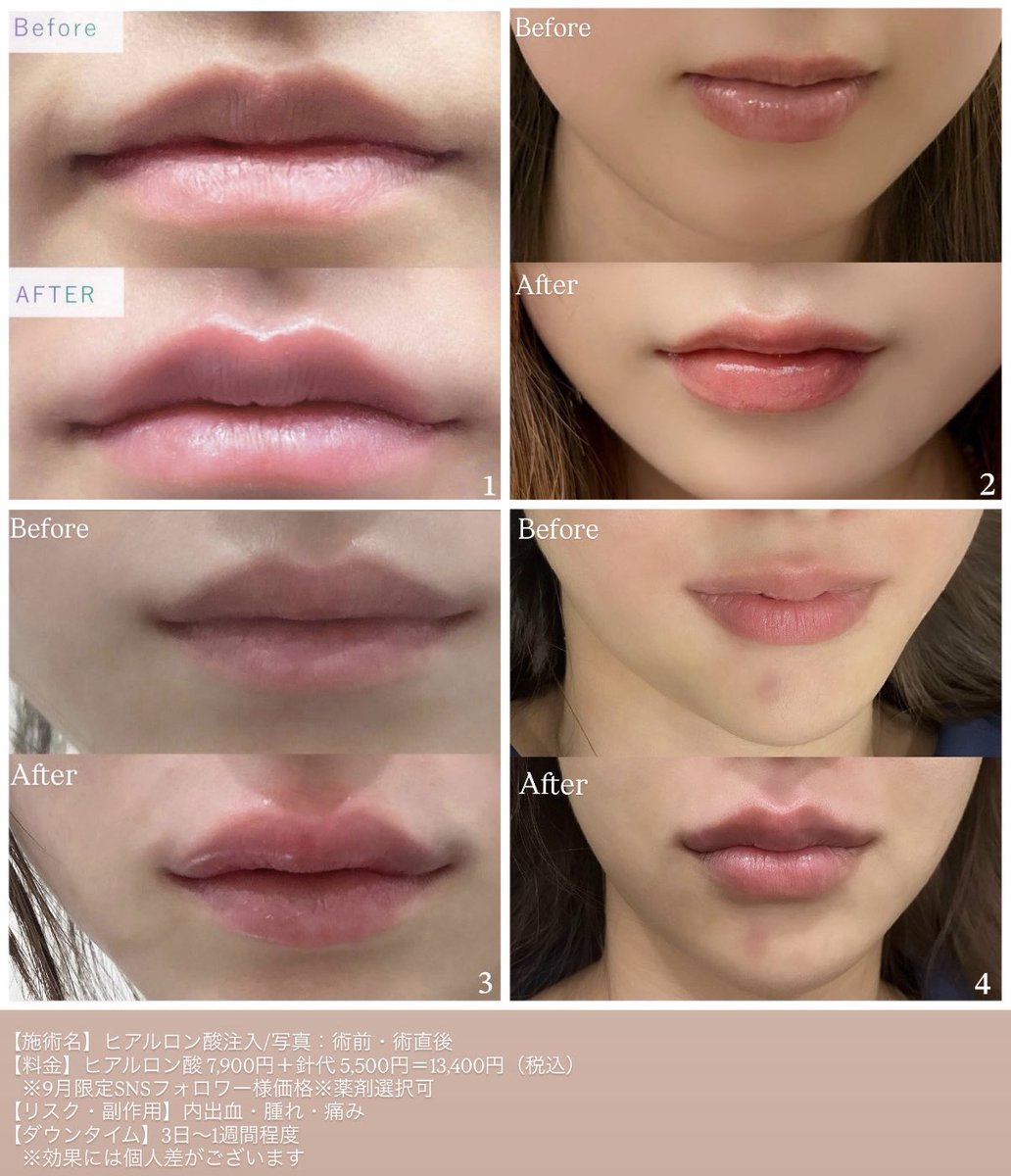 aloeclinic's tweet photo. ←涙袋ヒアル💧　　　　　唇ヒアル💋→

沢山の方にフォローいただきましたので、
ぜひ当院のヒアルロン酸のクオリティも見ていただきたいです。
全て違う常勤ドクターが施術しております。

術前/術直後
ヒアルロン酸 1cc7,900円（薬剤選択可）＋針代 5,500円＝13,400円（税込）でご案内可能🎀
※9月限定料金

ドクター指名は5,500円です。
気に入ったデザインがありましたら、
公式LINEにお問い合わせください✨