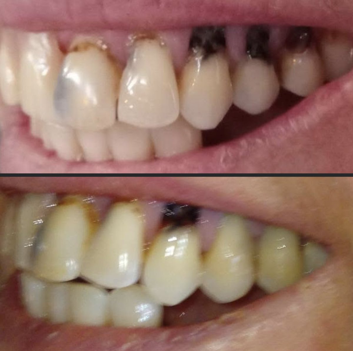 MagnusVigso's tweet photo. After 2 months of, 3gr borax in one liter
 water daily 

Pretty amazing results, you can heal every part of your body. https://t.co/ECJsGIqzeE