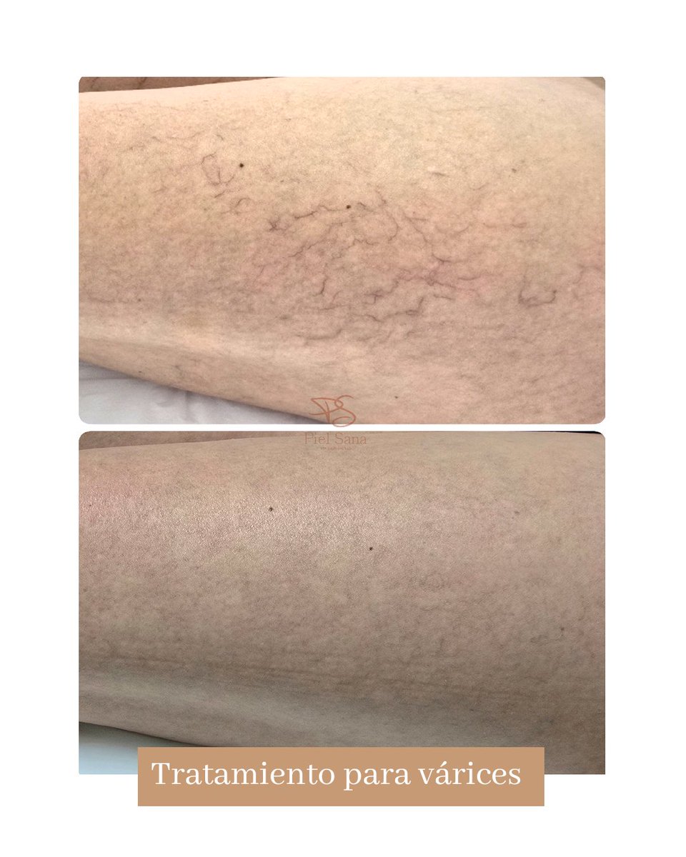 pielsanauy's tweet photo. F E L I C I D A D

Al devolverle a nuestras pacientes la salud y belleza de sus piernas.

Gracias por la confianza!

Agendá tu cita comunicándote por 092 171 515 o podés también visitar nuestra página web https://t.co/eHlteEVrO5 

#varices #varicesuruguay #varicesmontevideo https://t.co/FQ8N0rFE4s